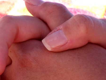 White Spots on Fingernails