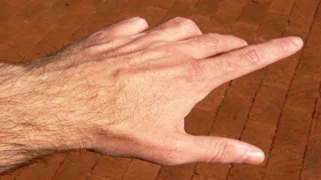 Can You Get Arthritis from Cracking or Popping Your Knuckles?