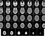 A horizontal cross-section scan of a human head, showing the brain, skull and face in grayscale