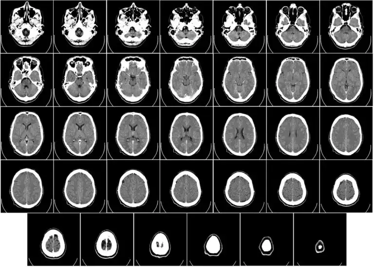 A horizontal cross-section scan of a human head, showing the brain, skull and face in grayscale